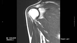 MR undersøkelse av skulder Normal [upl. by West63]