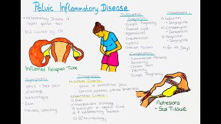 Pelvic Inflammatory Disease [upl. by Jimmie190]