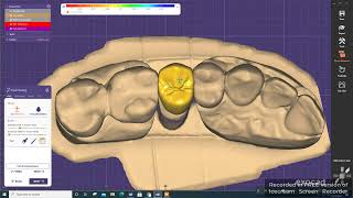 Exocad  Design perfect crown in 5 minutes [upl. by Yblek]