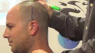 Tinnitus points of Yammaoto new scalp acupunctre [upl. by Beberg457]