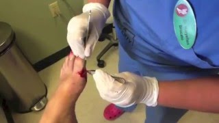 Surgical Removal of Ganglion Cyst [upl. by Zeitler]