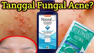 MABISANG PANTANGGAL NG TIGYAWAT SA NOO O FUNGAL ACNE  TREAT FUNGAL ACNE WITH NIZORAL SHAMPOO [upl. by Ellednahs803]