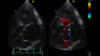 Echo image of AS subaortic stenosis in a dog 犬の大動脈弁下狭窄のエコー [upl. by Inihor]