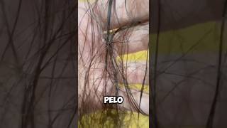 Caída de pelo posparto postpartum bebe maternidade paternidade alopecia lactancia embarazo [upl. by Tnahsarp]