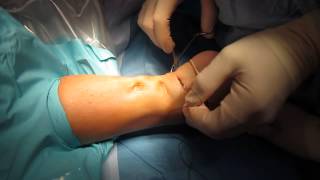 Percutaneous Achilles Tendon Surgery Repair Unedited by Kevin R Stone MD [upl. by Schindler]