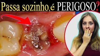 COMO RESOLVER a Alveolite Seca DOR ou Inflamação no LOCAL da Extração de Dente 74 [upl. by Manfred]