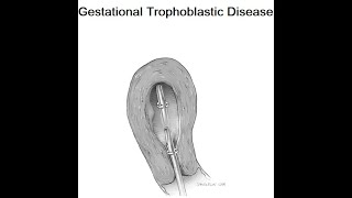 Gestational Trophoblastic Disease [upl. by Natsrik]