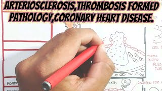 ArteriosclerosisThrombosis Formed PathologyCoronary Heart Disease umerfarooqbiology7083 [upl. by Feldman256]