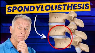 Spondylolisthesis 4 Exercises to Reduce Pain Demo on Real Patient [upl. by Meesaw]