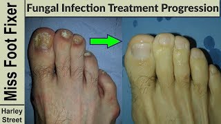 Nail Treatment Progression photo before and after by fungal nail expert [upl. by Trebo]