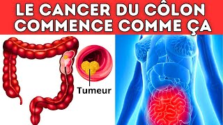 ALERTE  Ce symptôme étrange pourrait indiquer un cancer du côlon [upl. by Whitby918]