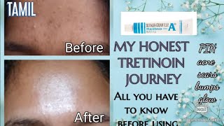 HOW TO USE TRETINOIN 0025 THIS IS WHAT I THINK AFTER 5 MONTHS OF USAGE TRETINOIN TAMIL REVIEW [upl. by Ardnuasac765]