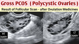 Polycystic Ovaries  Gross Grade 3  PCOS  Ultrasound after Ovulation Medication [upl. by Whit690]