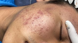 ACNE TREATMENT VU QUYNH MI  Blackheads Of Tweens 2024 EX [upl. by Wilie520]