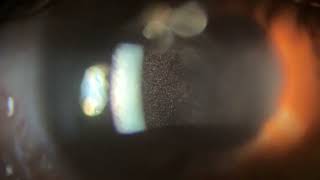 The best video of cells in the anterior chamber [upl. by Yuria]