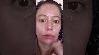 suavicid clarea o melasma [upl. by Audy]