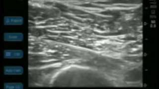 Ultrasound Guided Popliteal Sciatic Nerve Block [upl. by Rellek458]