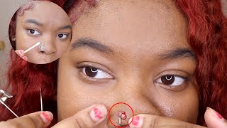 How to pop and Get rid of nose piercing bump keloid FAST [upl. by Fevre]