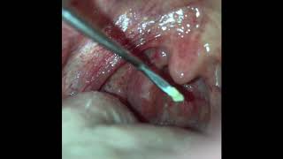 Multiple Tonsil Stones Extracted [upl. by Mall68]