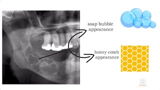 Ameloblastoma part 1 [upl. by Rossy]