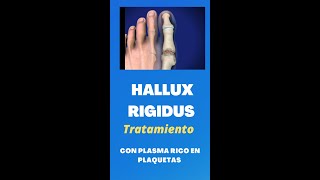 Hallux Rigidus Cero Dolor con Plasma [upl. by Ossy]