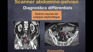 Lithiase Urinaire  3 Diagostics différentiels [upl. by Cired154]