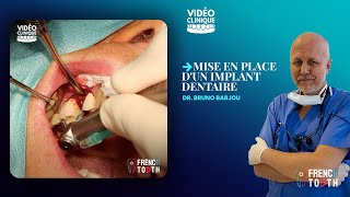 Mise en place dun implant dentaire  Dr Barjou [upl. by Busiek689]