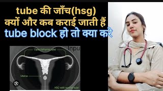 tube की जाँच HSGक्यों और कब की जाती हैं what is HSG test hsgtestinfertilitytubetubetestreels [upl. by Reedy103]