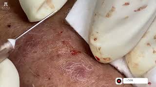 Big Cystic Acne Blackheads Extraction Blackheads amp Milia Whiteheads Removal Pimple Popping 2024 [upl. by Franzoni161]