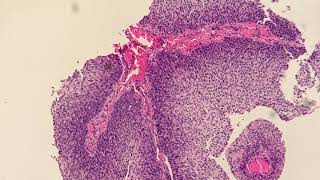 Invasive Non Keratinizing Squamous Cell Carcinoma Moderately Differentiated [upl. by Mckale]