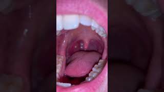 Huge tonsil stone removal [upl. by Macrae969]