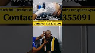 Hair Transplant Surgery after 10 Day shorts Howtowashhair [upl. by Inek]