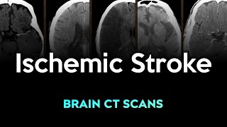 Ischemic Stroke Brain CT Scans [upl. by Gertrude]