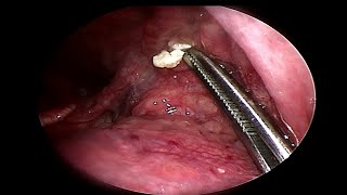 Removing LARGE Tonsil Stone  Doctor Anh [upl. by Nwahsel]