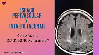 Espaço perivascular x infarto lacunar o DIAGNÓSTICO diferencial [upl. by Varin]