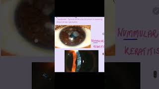 Nummular keratitis cornea keratitis eyes ophthalmology [upl. by Ahsiyk]