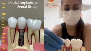 DENTAL Implants vs Dental BRIDGE [upl. by Leanard289]