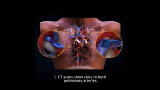 Pulmonary Saddle Embolism [upl. by Diaz840]