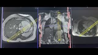 Planning of 2CH VIEW cardiacMRI [upl. by Frederiksen]