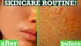 HOW TO GET RID OF TINY BUMPS ON FACE SKIN TEXTURE  ACNE CLEAR SKIN CARE ROUTINE  Giveaway [upl. by Cathee]