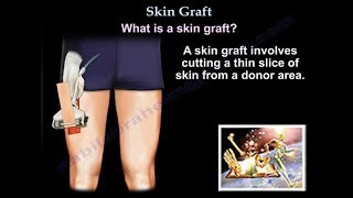 Skin Graft  Everything You Need To Know  Dr Nabil Ebraheim [upl. by Dill]