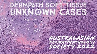 Dermpath Soft Tissue Pathology Cases for Australasian Dermatopathology Society 2022 meeting [upl. by Nugent]