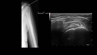 Ultrasound guided subacromial steroid injection calcific tendinitis and bursitis [upl. by Ailatan748]