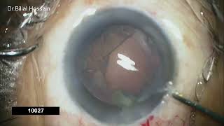 Mellifluous management of cataract surgery by Phacoemulsification  Dr Billal Hossain [upl. by Anaiuq28]