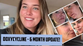 DOXYCYCLINE  6 month update ACNE JOURNEY [upl. by Nanahs]