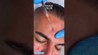 Achieve Youthful Look with Forehead Filler at EDEN AESTHETICS Dubai  NonSurgical Wrinkle Reduction [upl. by Griffie252]