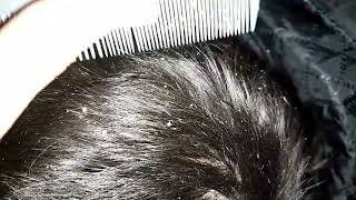 dandruff scratching removal 10 [upl. by Day359]