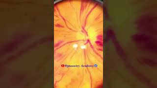 Flame shaped Hemorrhages  proliferative diabetic retinopathy PDR  Short Video 180 [upl. by Chader]