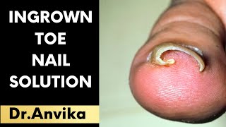 Ingrown Toe Nail Solution  Dr Anvika  9999 747 717  8287001211 [upl. by Atinat773]