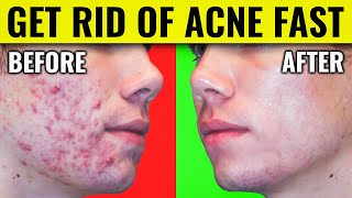 Say Goodbye to Acne Dr Bergs Proven Methods for Clearing Your Skin [upl. by Peale]